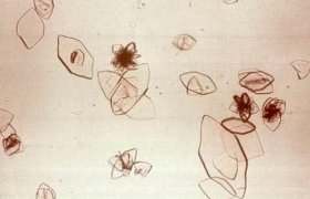 This photograph shows uric acid crystals in urine, when viewed using a microscope. Their birefringence under a polarizing microscope helps to discriminate uric acid crystals from other types of crystals, but biochemical analysis is required to reveal the chemical composition.